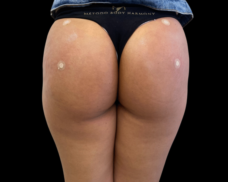 Glúteos depois do body harmony